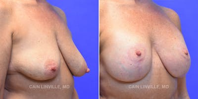 Breast Lift Before & After Gallery - Patient 119939981 - Image 4