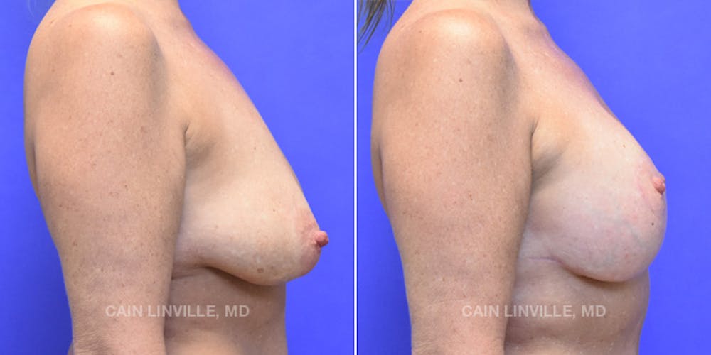 Breast Lift Before & After Gallery - Patient 119939981 - Image 5
