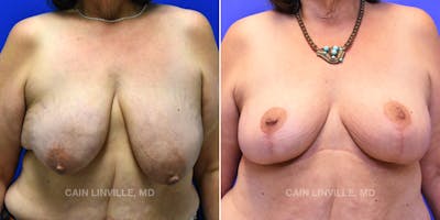 Breast Lift Before & After Gallery - Patient 119939976 - Image 1