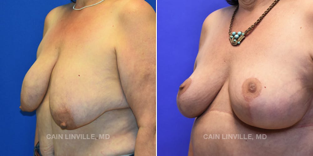 Breast Lift Before & After Gallery - Patient 119939976 - Image 2