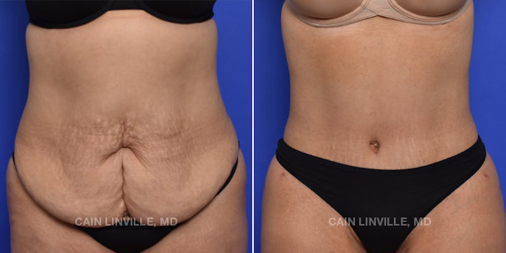 Tummy Tuck (Abdominoplasty) Before & After Gallery - Patient 119940297 - Image 1