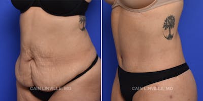 Tummy Tuck (Abdominoplasty) Before & After Gallery - Patient 119940297 - Image 2