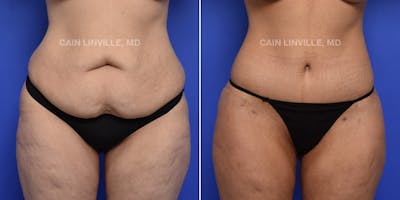 Tummy Tuck (Abdominoplasty) Before & After Gallery - Patient 119941758 - Image 1