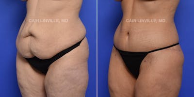 Tummy Tuck (Abdominoplasty) Before & After Gallery - Patient 119941758 - Image 2