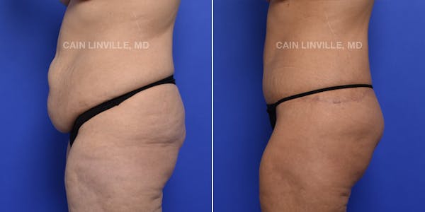 Tummy Tuck (Abdominoplasty) Before & After Gallery - Patient 119941758 - Image 3