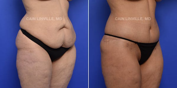 Tummy Tuck (Abdominoplasty) Before & After Gallery - Patient 119941758 - Image 4