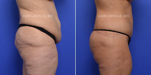 Tummy Tuck (Abdominoplasty) Before & After Gallery - Patient 119941758 - Image 5