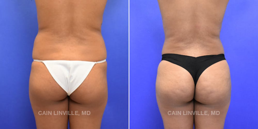 Brazilian Butt Lift (BBL) Before & After Gallery - Patient 119942029 - Image 1