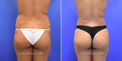 Brazilian Butt Lift (BBL) Before & After Gallery - Patient 119942029 - Image 1