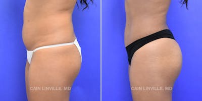 Brazilian Butt Lift (BBL) Before & After Gallery - Patient 119942029 - Image 2