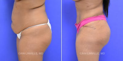 Brazilian Butt Lift (BBL) Before & After Gallery - Patient 119942030 - Image 1