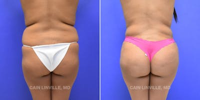 Brazilian Butt Lift (BBL) Before & After Gallery - Patient 119942030 - Image 2