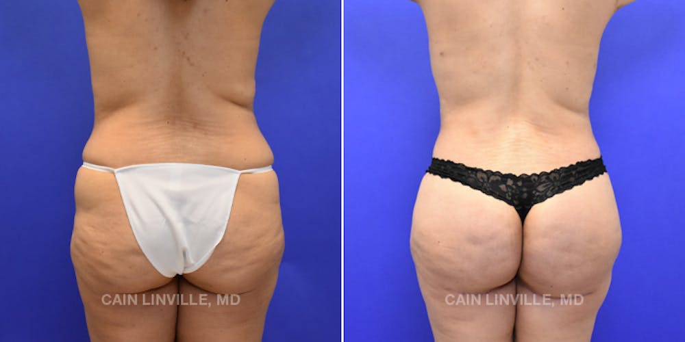 Brazilian Butt Lift (BBL) Before & After Gallery - Patient 119942188 - Image 1