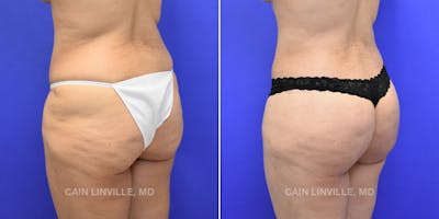 Brazilian Butt Lift (BBL) Before & After Gallery - Patient 119942188 - Image 2