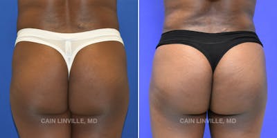 Brazilian Butt Lift (BBL) Before & After Gallery - Patient 119942189 - Image 1