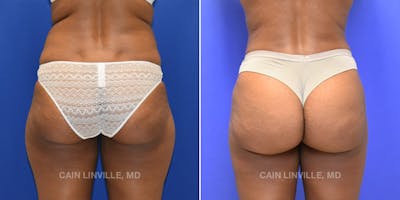 Brazilian Butt Lift (BBL) Before & After Gallery - Patient 119942190 - Image 1