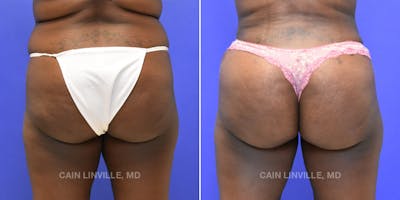 Brazilian Butt Lift (BBL) Before & After Gallery - Patient 119942191 - Image 1