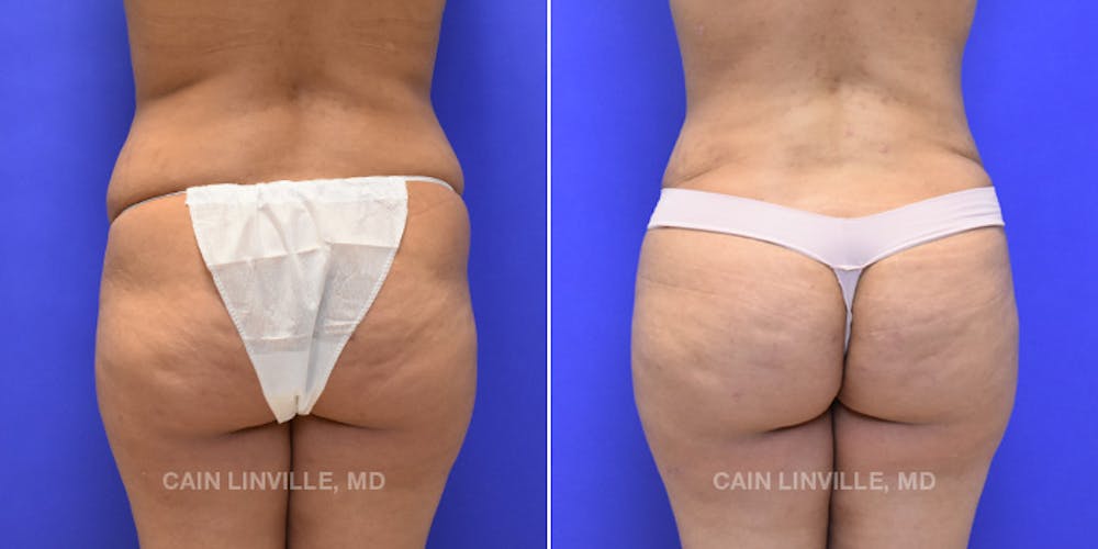 Brazilian Butt Lift (BBL) Before & After Gallery - Patient 119942192 - Image 1