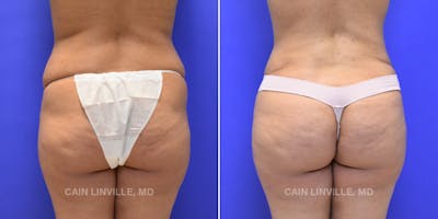 Brazilian Butt Lift (BBL) Before & After Gallery - Patient 119942192 - Image 1