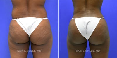 Brazilian Butt Lift (BBL) Before & After Gallery - Patient 119942193 - Image 1