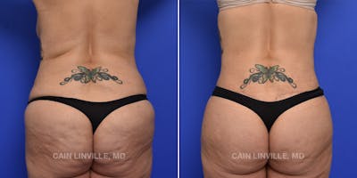 Brazilian Butt Lift (BBL) Before & After Gallery - Patient 119942194 - Image 1