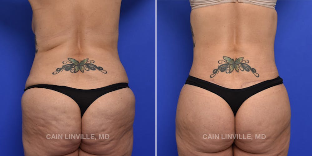 Brazilian Butt Lift (BBL) Before & After Gallery - Patient 119942194 - Image 1