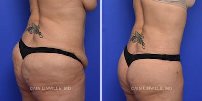 Brazilian Butt Lift (BBL) Before & After Gallery - Patient 119942194 - Image 2