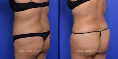 Brazilian Butt Lift (BBL) Before & After Gallery - Patient 119942196 - Image 1