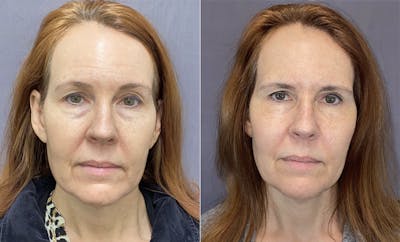 Lower Blepharoplasty Before & After Gallery - Patient 120352240 - Image 1