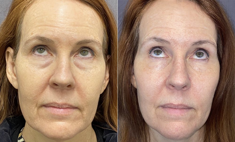 Lower Blepharoplasty Before & After Gallery - Patient 120352240 - Image 2