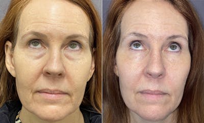 Lower Blepharoplasty Before & After Gallery - Patient 120352240 - Image 2