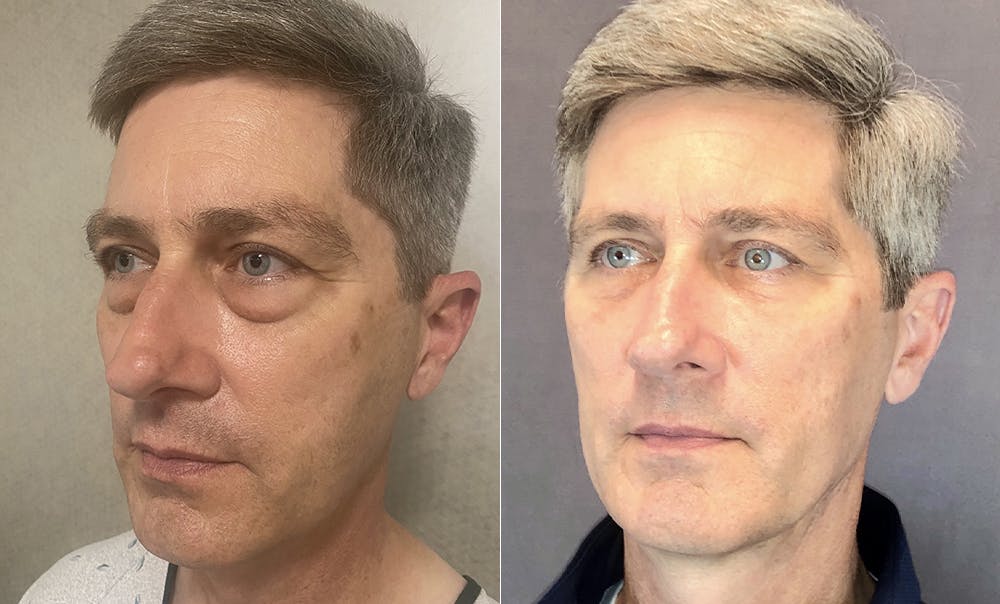 Patient 120352364 | Lower Blepharoplasty Before & After Photos | Austin Face & Body