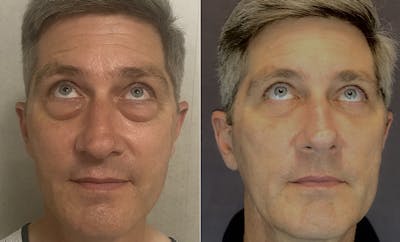 Lower Blepharoplasty Before & After Gallery - Patient 120352364 - Image 2