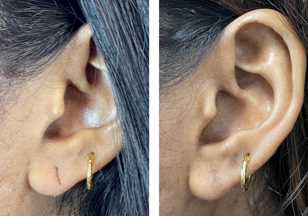 Ear Surgery Before & After Gallery - Patient 120378026 - Image 1