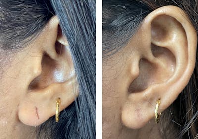 Ear Surgery Before & After Gallery - Patient 120378026 - Image 1