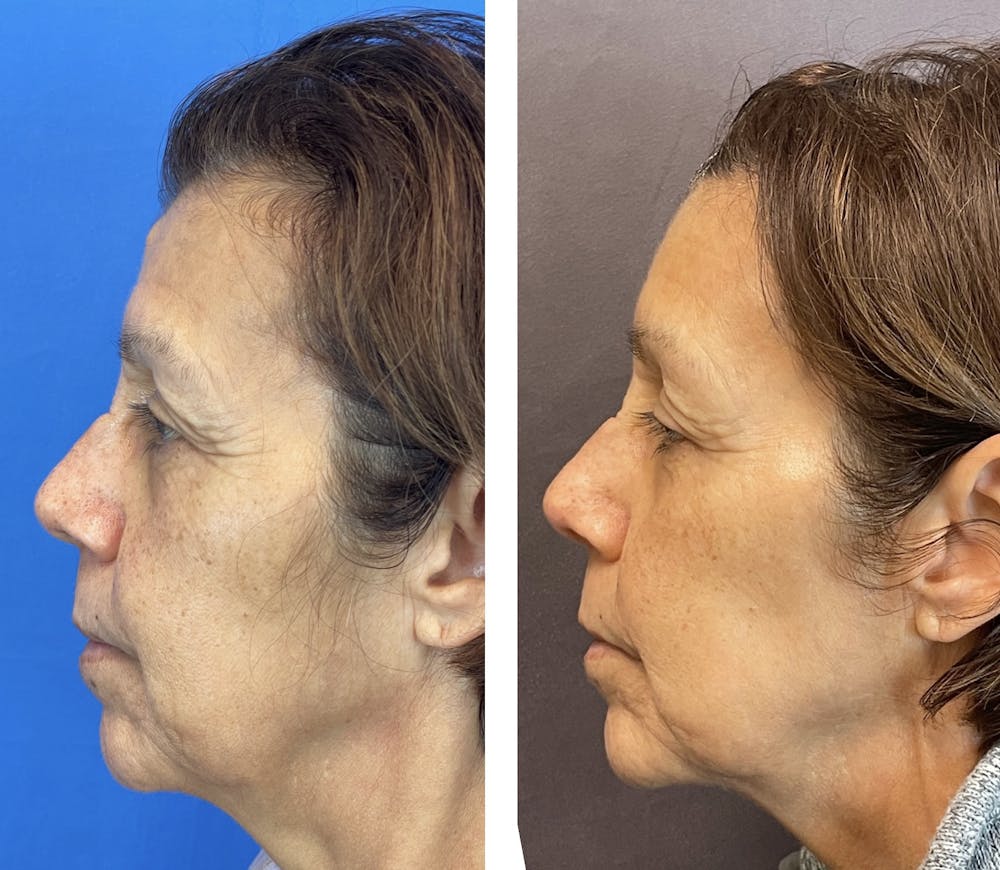 Lipoma Removal Before & After Gallery - Patient 120378071 - Image 3
