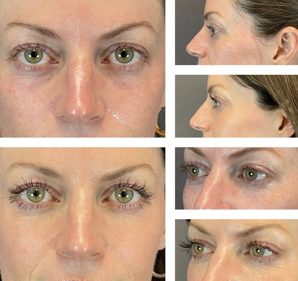 Dermal Fillers Before & After Gallery - Patient 119935090 - Image 5
