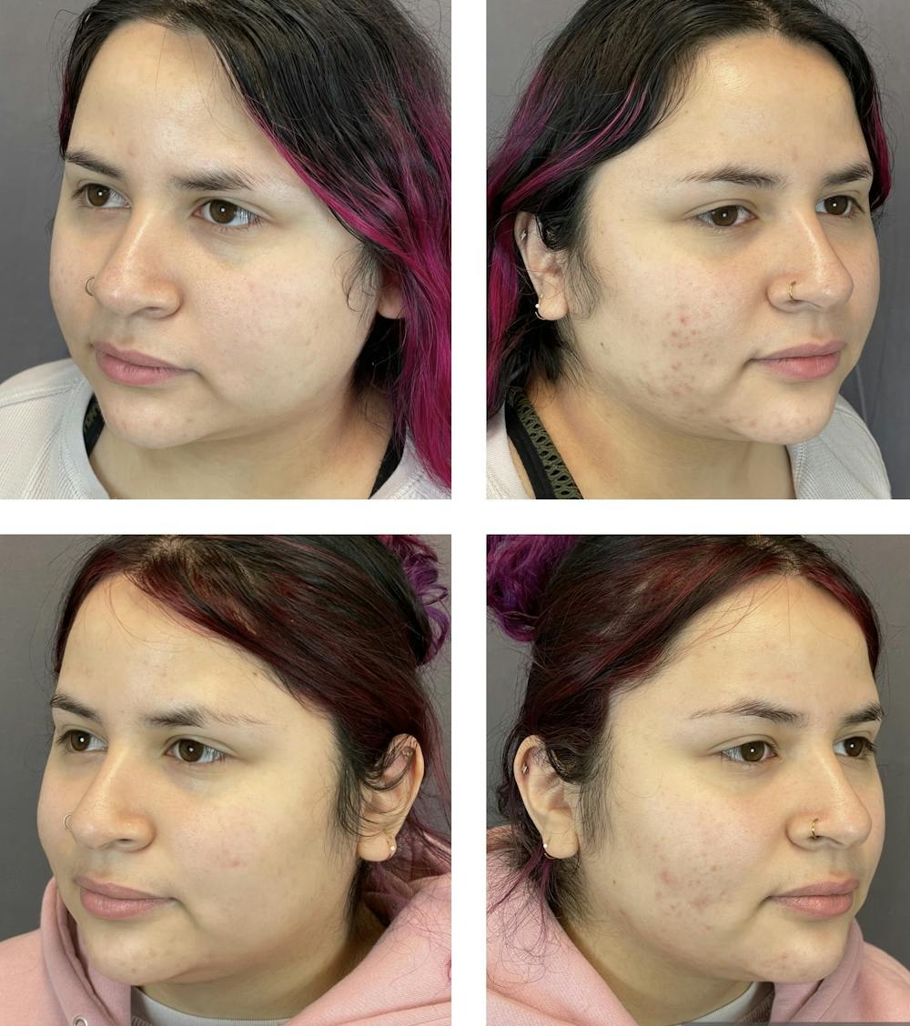 Buccal Fat Reduction Before & After Gallery - Patient 120378141 - Image 1