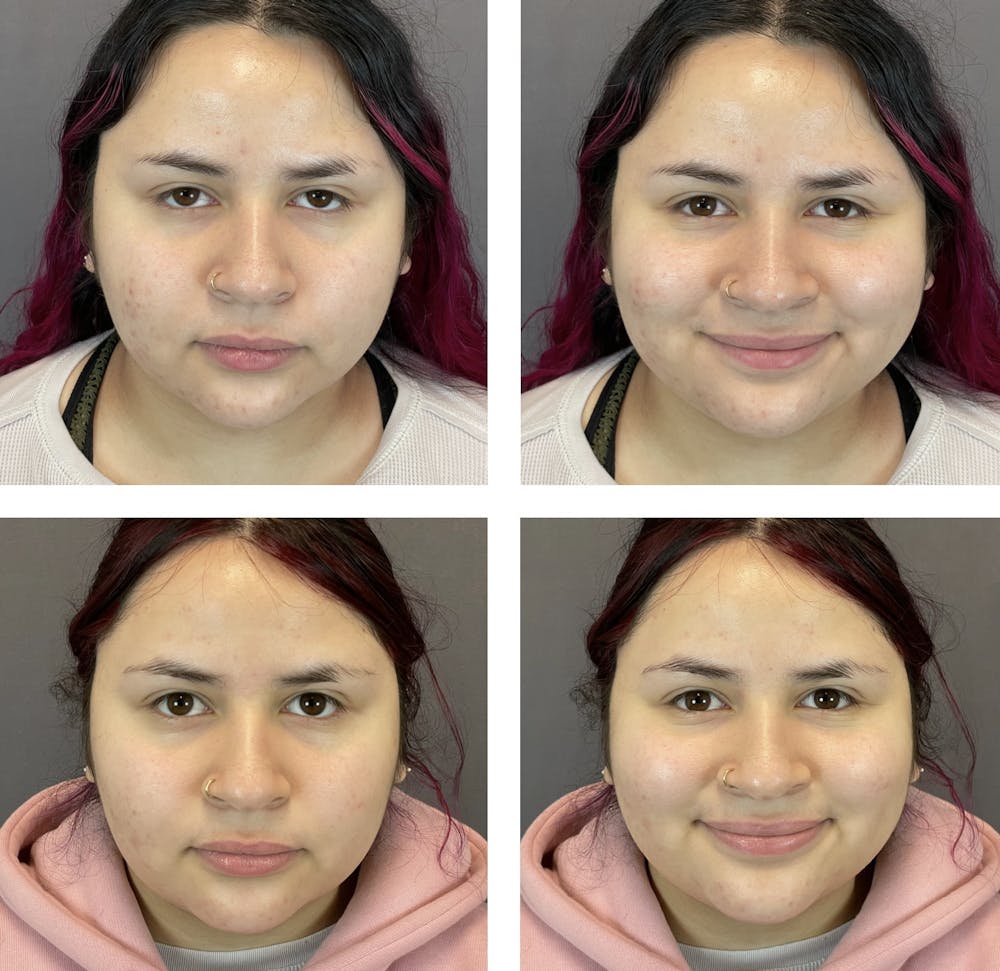 Buccal Fat Reduction Before & After Gallery - Patient 120378141 - Image 2