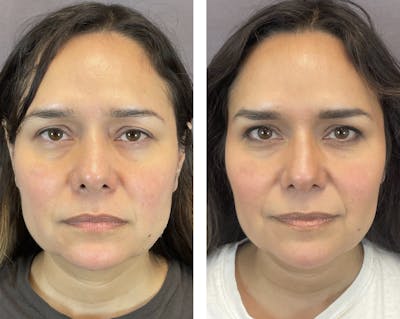 Brow Lift Before & After Gallery - Patient 120378176 - Image 1