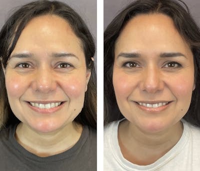 Brow Lift Before & After Gallery - Patient 120378176 - Image 2