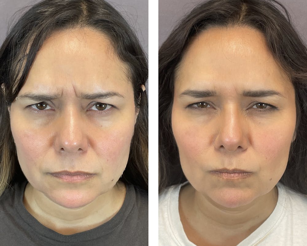 Brow Lift Before & After Gallery - Patient 120378176 - Image 3