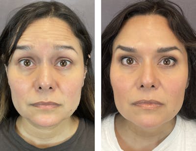 Brow Lift Before & After Gallery - Patient 120378176 - Image 4