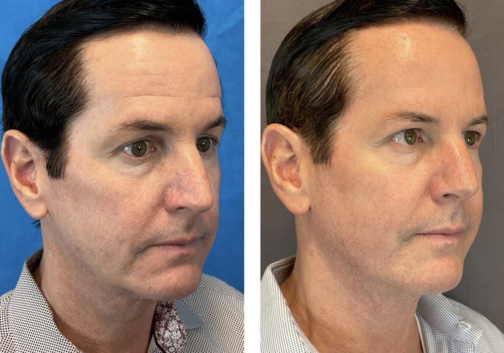 Dermal Fillers Before & After Gallery - Patient 120378195 - Image 2