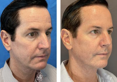 Dermal Fillers Before & After Gallery - Patient 120378195 - Image 2