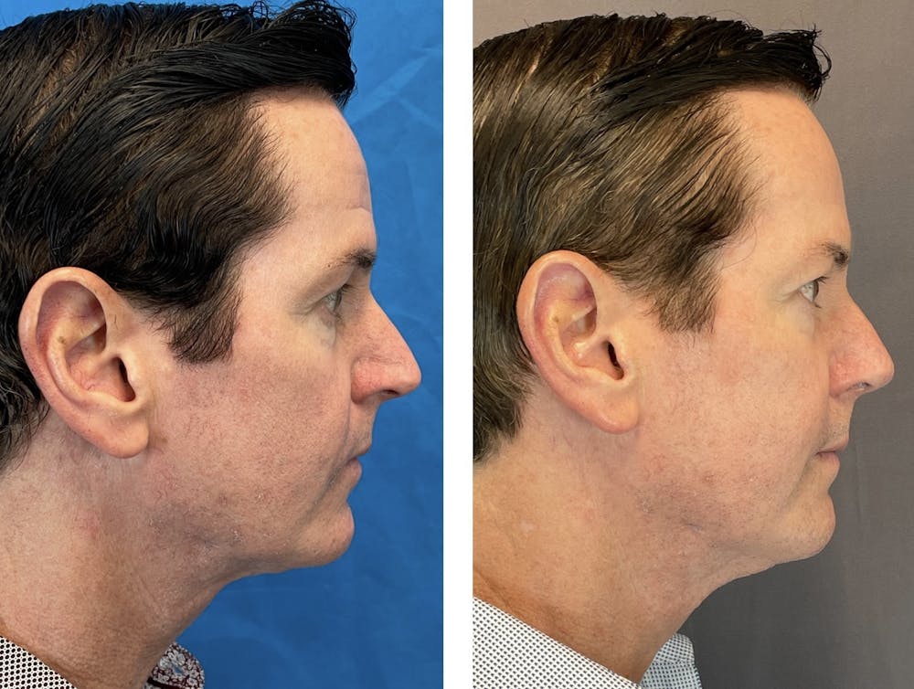 Dermal Fillers Before & After Gallery - Patient 120378195 - Image 3