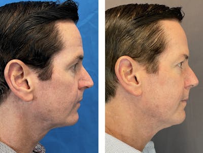 Rhinoplasty Before & After Gallery - Patient 120378190 - Image 1