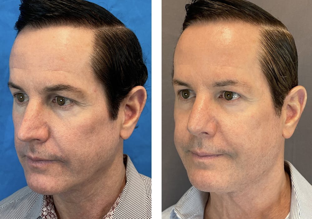 Dermal Fillers Before & After Gallery - Patient 120378195 - Image 4