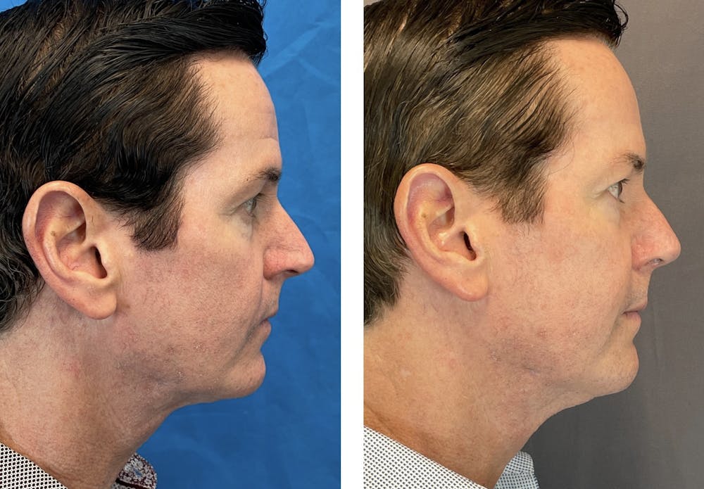 Dermal Fillers Before & After Gallery - Patient 120378195 - Image 5