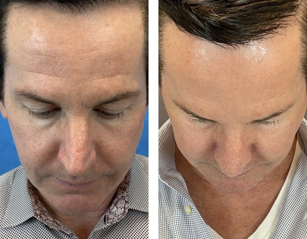 Dermal Fillers Before & After Gallery - Patient 120378195 - Image 6